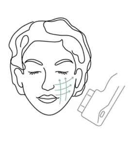 HIFU skin tightening treatment at Skinworks in Durbanville for lifting, firming and facial rejuvenation without surgery.