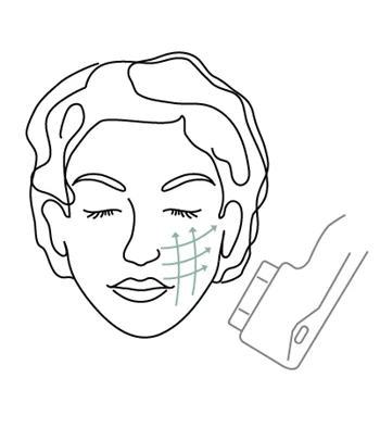 HIFU skin tightening treatment at Skinworks in Durbanville for lifting, firming and facial rejuvenation without surgery.